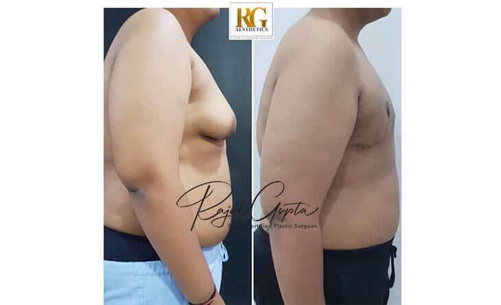 gynecomastia surgery before and after