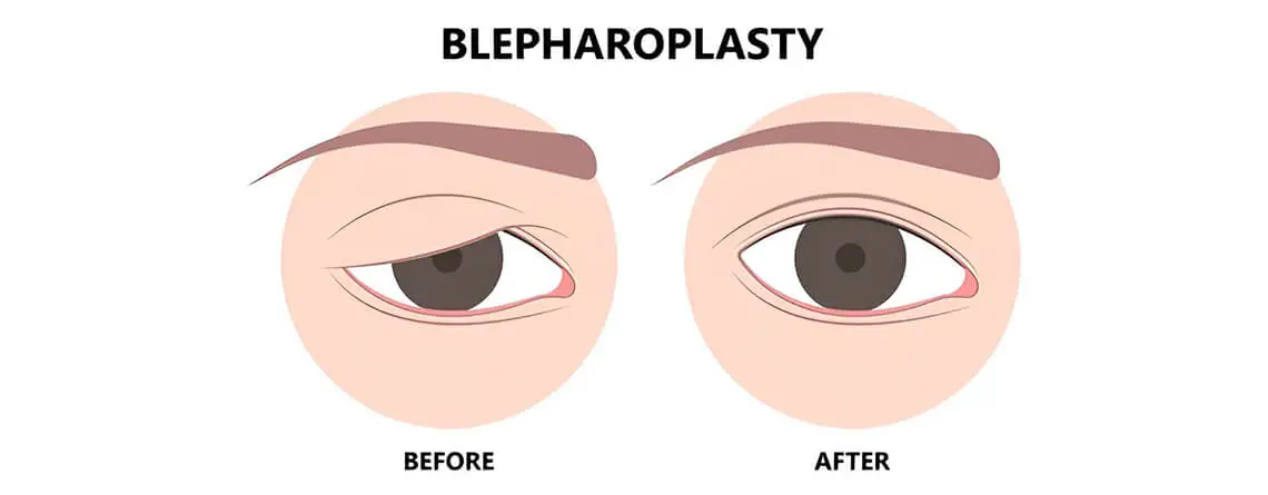 eyelid surgery