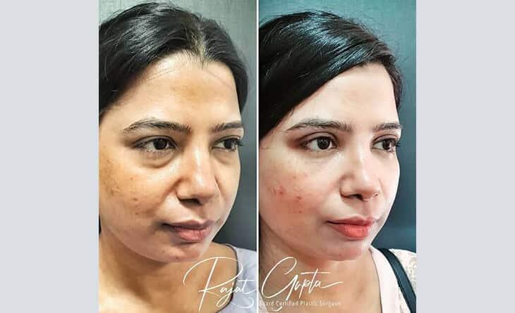 eyelid surgery before and after