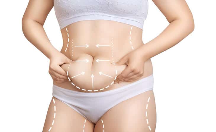 Liposuction surgery