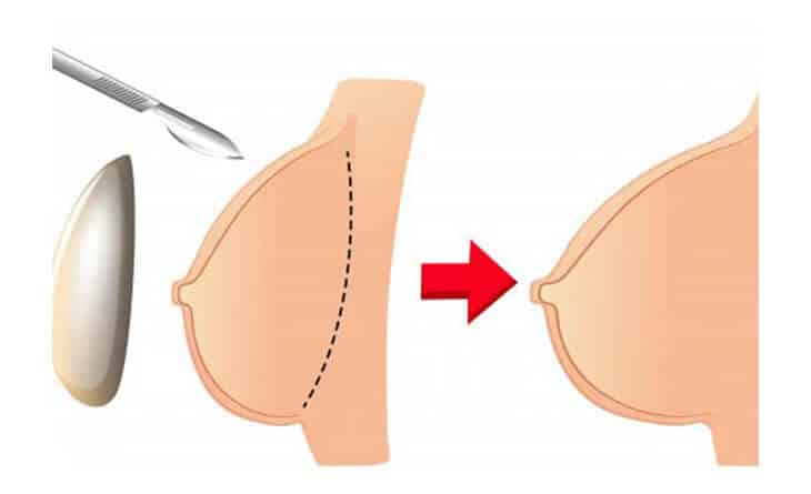 Breast Reconstruction surgery