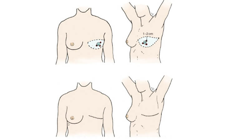 Breast Reconstruction surgery