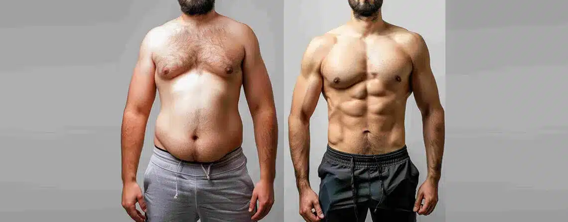 Gynecomastia Surgery