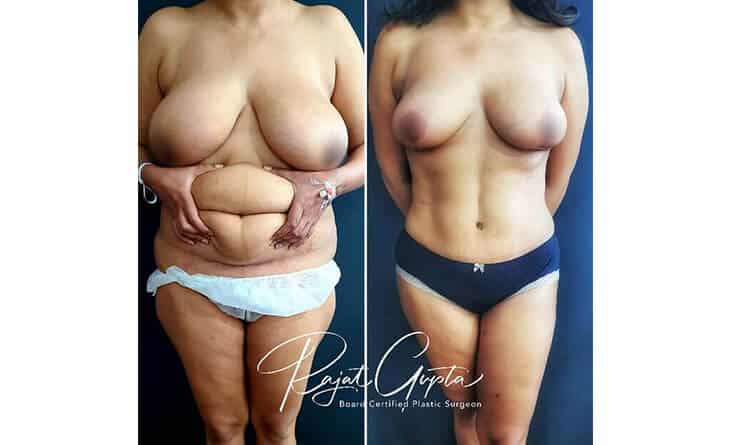 Mommy Makeover Surgery