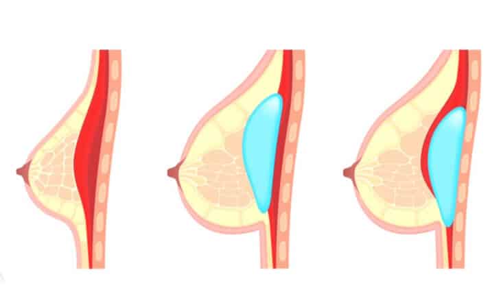 Breast augmentation surgery
