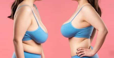 Perky breast surgery