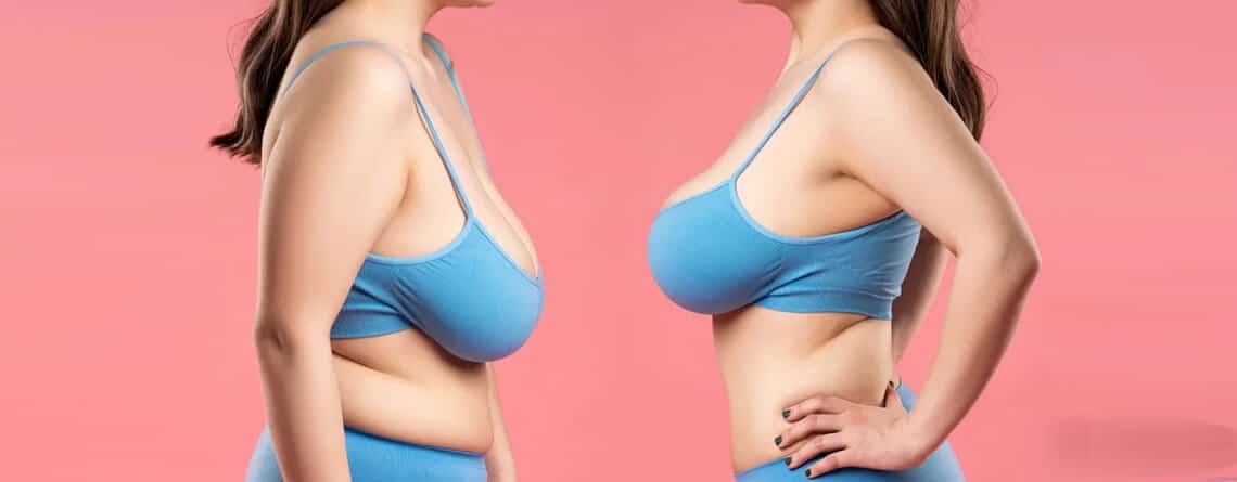 Perky breast surgery