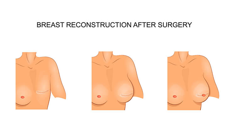 Breast Reconstruction surgery