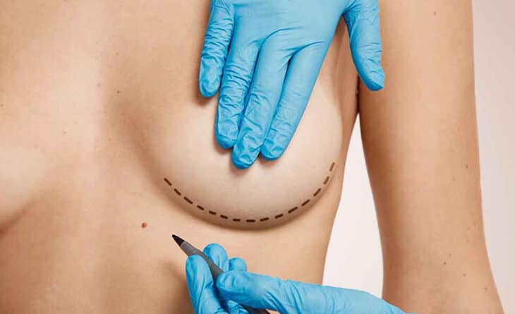 Breast reconstruction surgery