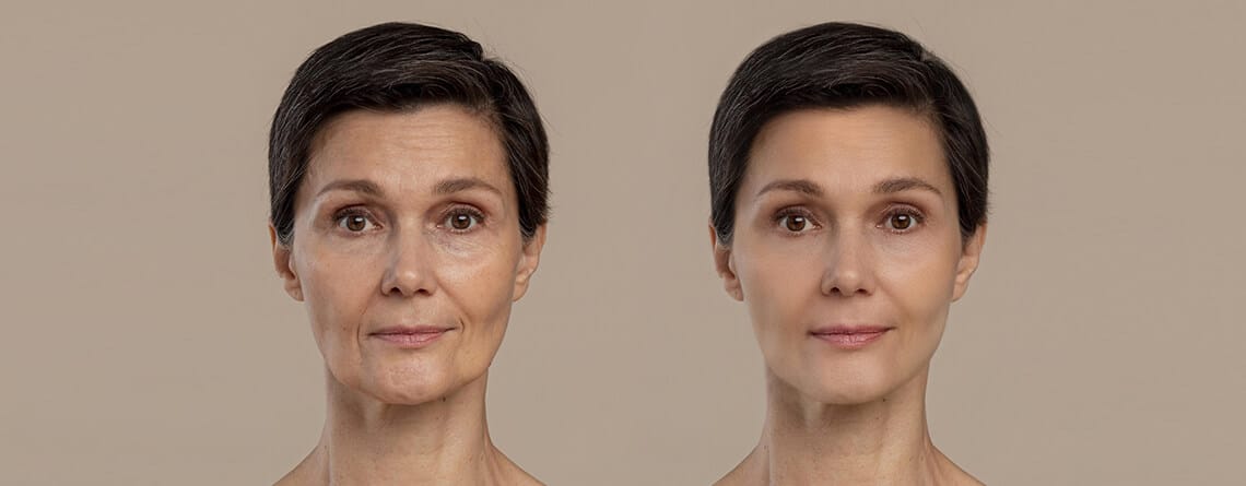 Facial Contouring Surgery