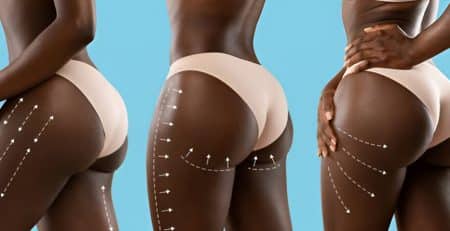 Brazilian Butt Lift Surgery