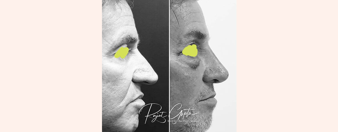 Celebrity Rhinoplasty Surgery