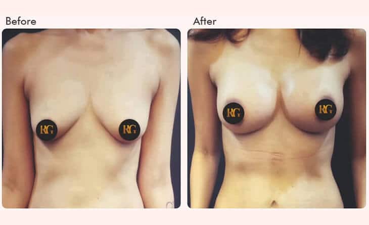 Breast augmentation surgery before and after