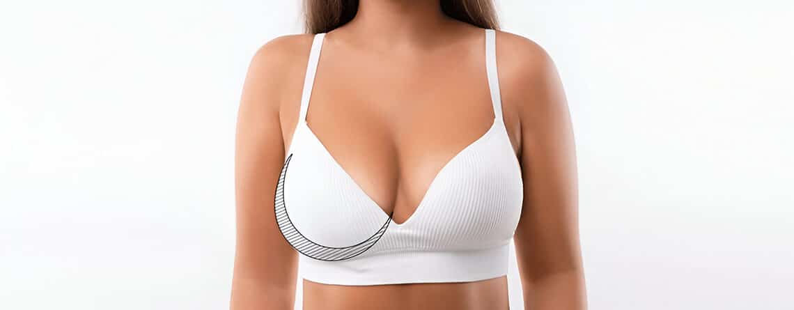 breast reduction surgery