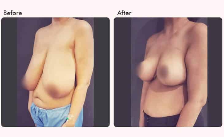 breast reduction surgery before and after