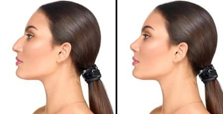 droopy nose causes