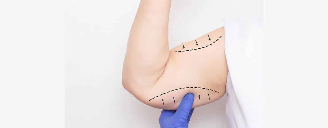 arm lift surgery