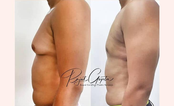 gynecomastia surgery before and after