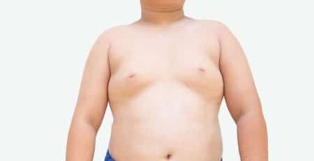 gynecomastia surgery