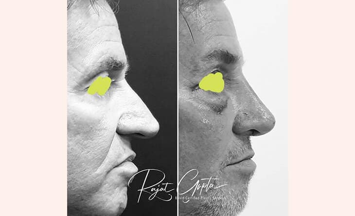 Nose job surgery before and after