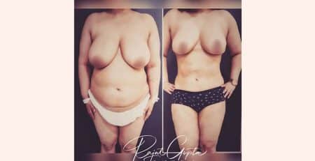 liposuction surgery