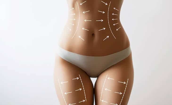 liposuction surgery