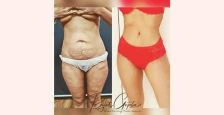 tummy tuck surgery before and after