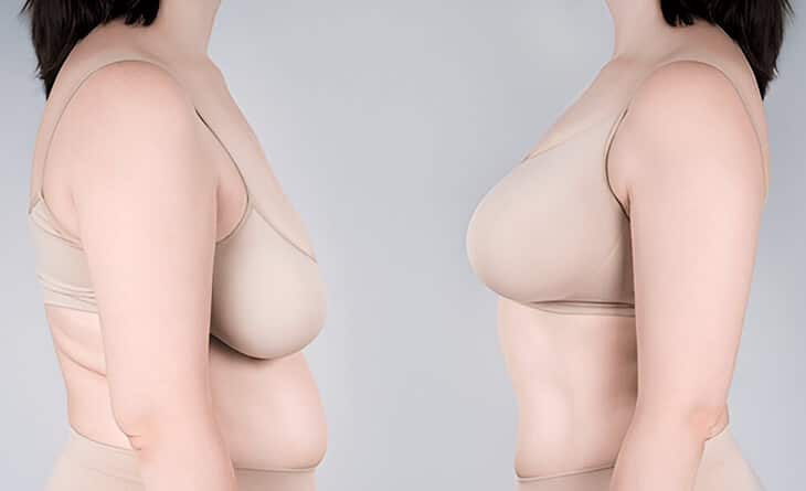 Upper Pole Fullness Breast Reduction