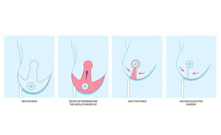 Upper Pole Fullness Breast Reduction