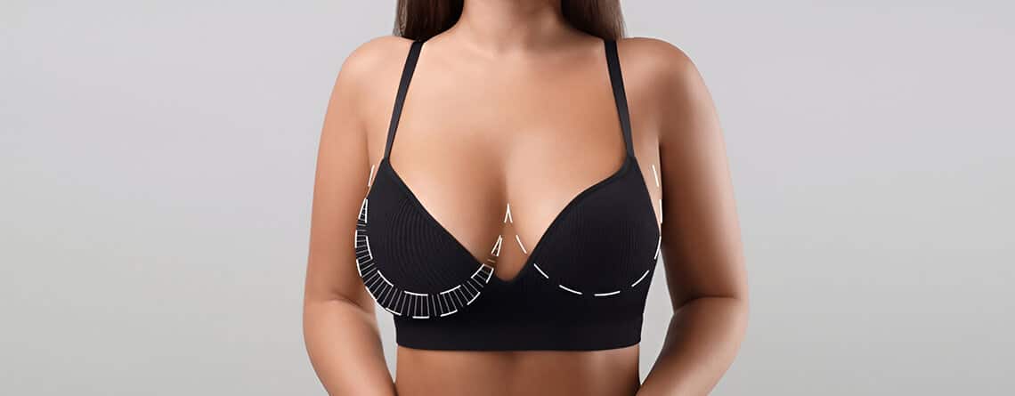 Upper Pole Fullness Breast Reduction