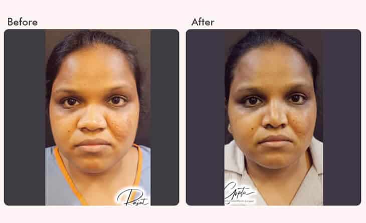 rhinoplasty surgery before and after