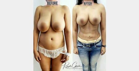 Breast Reduction Surgery before and after