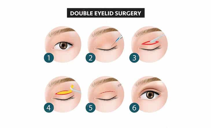 double eyelid surgery