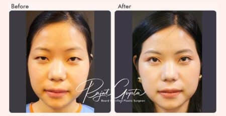 double eyelid surgery