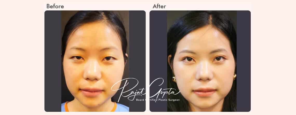 double eyelid surgery