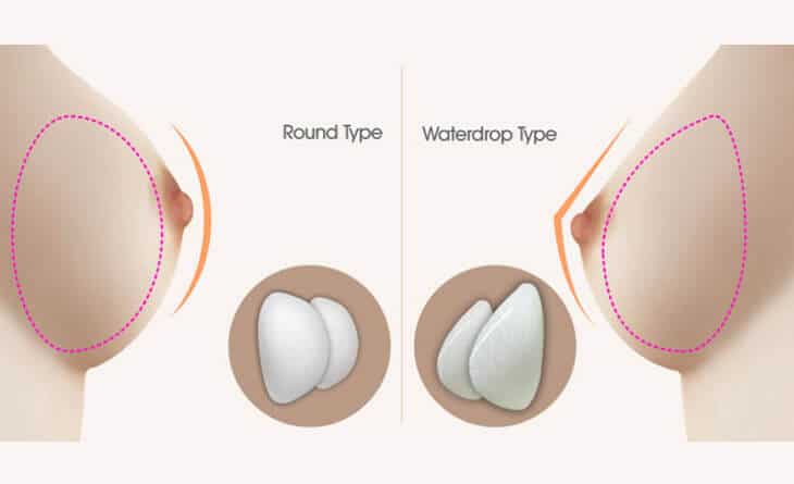 Breast implant