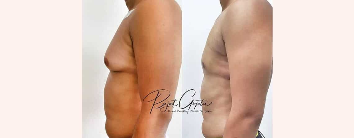 Gynecomastia surgery before and after