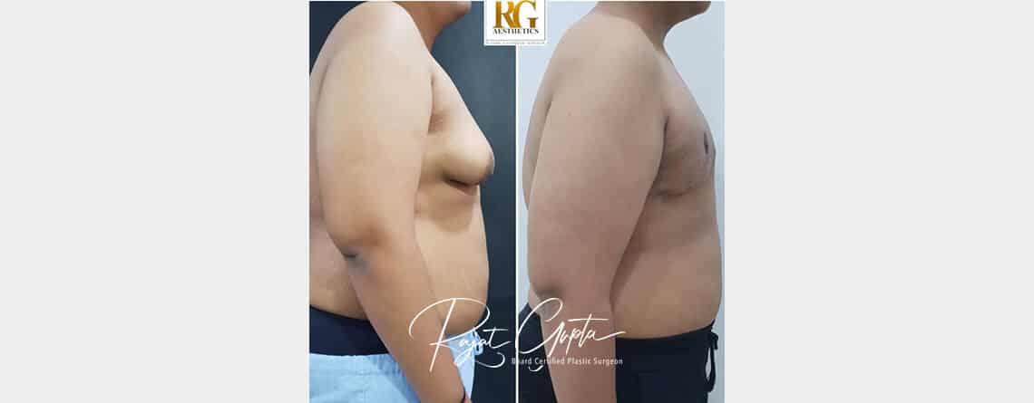 Say Goodbye to Male Breast Enlargement with the OCCULT Technique - Dr Rajat Gupta