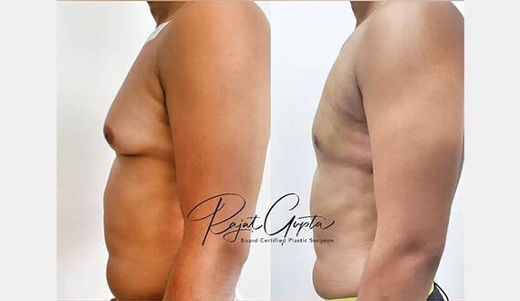 Scar-Free Gynecomastia Surgery in Delhi - Dr Rajat Gupta