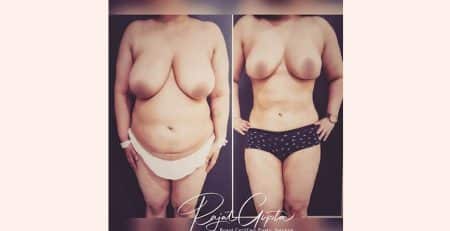 Liposuction surgery before and after
