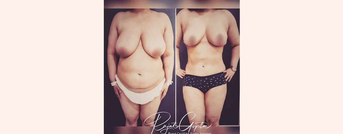 Liposuction surgery before and after