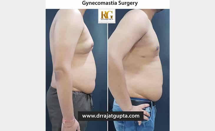 scarless gynecomastia surgery Delhi