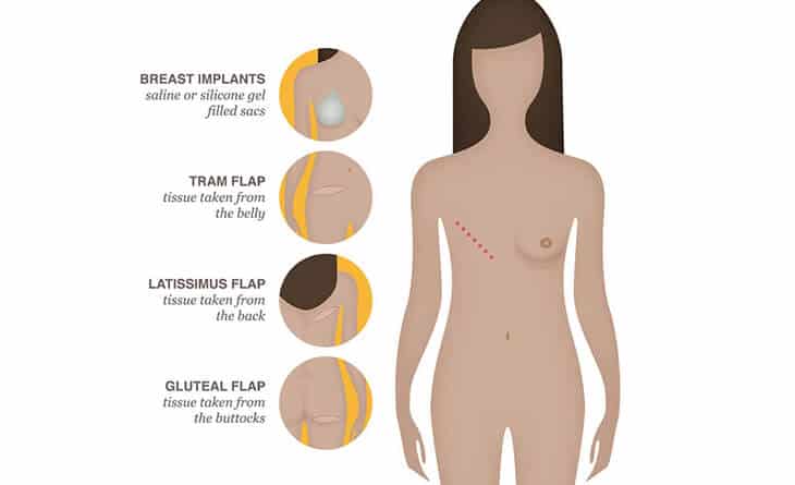 Breast Reconstruction Surgery