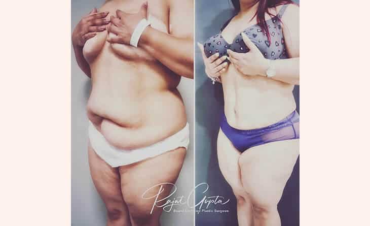 high definition abdominoplasty before and after