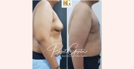 OCCULT technique gynecomastia surgery
