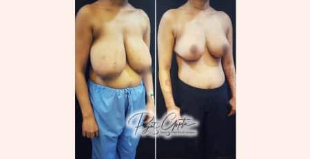 RG flap natural lift breast reduction