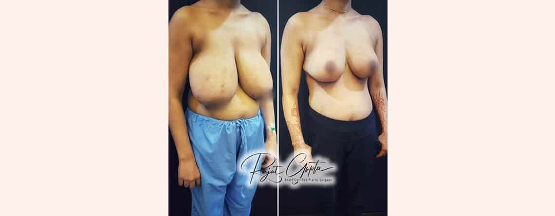 RG flap natural lift breast reduction