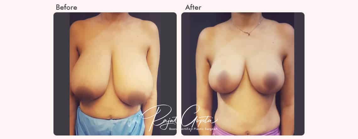 breast reduction surgery before and after