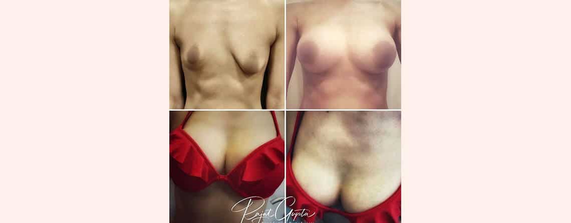 Breast Augmentation in Delhi