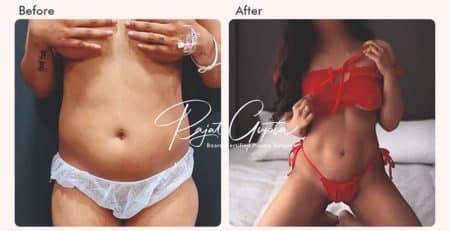 Liposuction Surgery Before and After